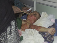 A mother nursing her injured boy at a hospital in Sanaa. Many children are a victim of their parents carelessness in mishandling gas cylinders.