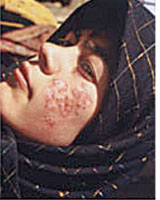 Though not fatal, visceral leishmania destroys the skin. The lesions remain localized in the skin and skin ulcers develop.