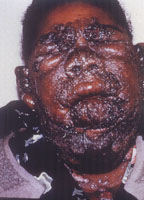 Chronic cutaneous coccidioidomycosis showing granulomatous lesions on face, neck and chin.